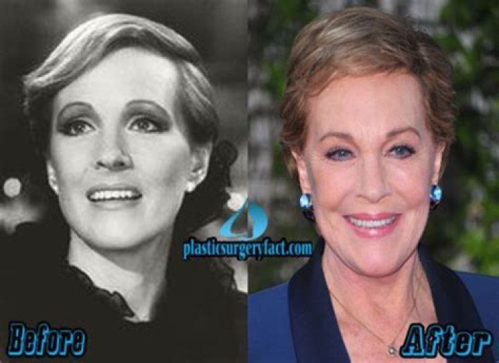 Julie Andrews' Plastic Surgery: The Complete Guide